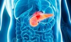 El trasplante fecal, nueva clave para los cáncer de páncreas más agresivos