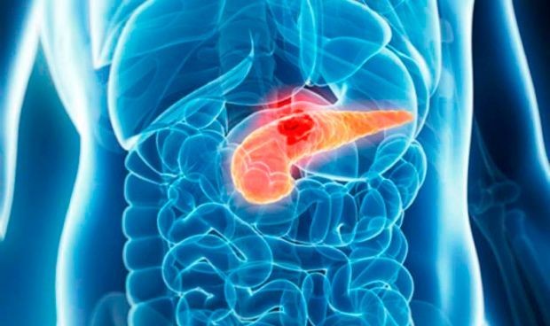 El trasplante fecal, nueva clave para los cáncer de páncreas más agresivos