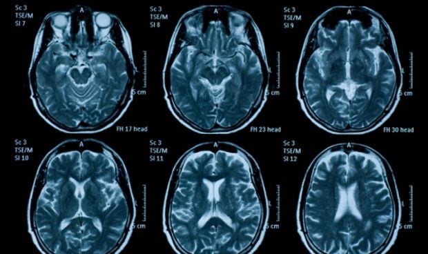 El trastorno del espectro autista está vinculado con la forma del cerebelo