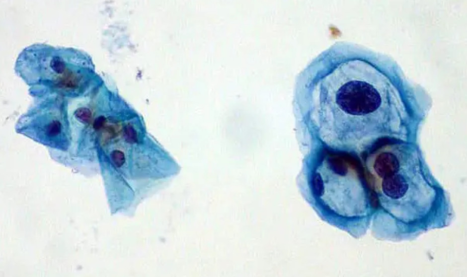 Virus del Papiloma Humano, capaz de generar crecimiento tumoral