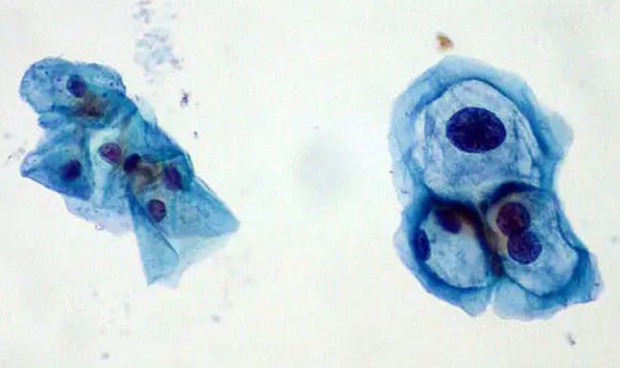 Virus del Papiloma Humano, capaz de generar crecimiento tumoral