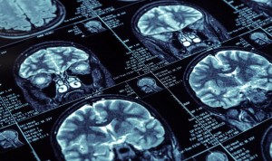 Elaboran un mapa completo de cómo el alzhéimer afecta al cerebro
