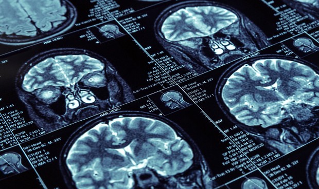 Elaboran un mapa completo de cómo el alzhéimer afecta al cerebro