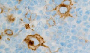 En 2020 se diagnosticarán 18.000 nuevas neoplasias linfoides en España