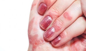 En artritis psoriásica: ¿qué es antes, la psoriasis o la artritis?