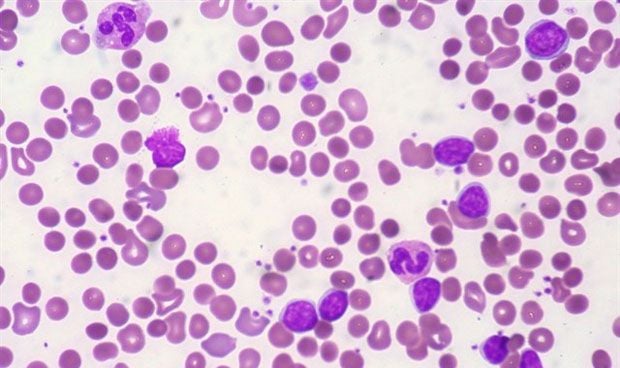 Encuentran dianas epigenéticas contra la leucemia mieloide aguda