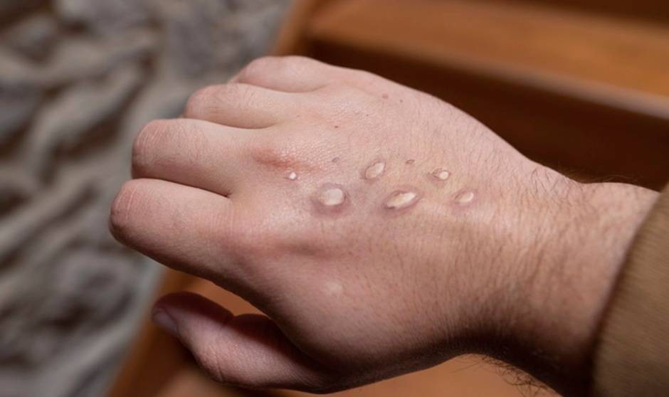 España, a la cabeza de casos de monkeypox en Europa, duplica a Reino Unido