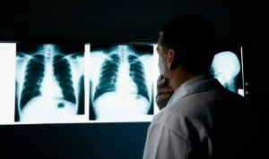España, de los países europeos que menos invierten en cáncer de pulmón