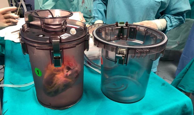 España estrena un revolucionario método para transportar órganos