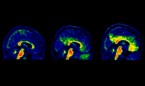 Establecen un umbral más bajo para comenzar la prevención del alzhéimer