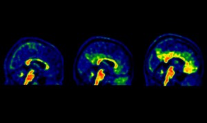 Establecen un umbral más bajo para comenzar la prevención del alzhéimer