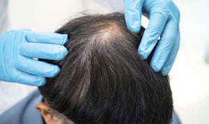 Europa identifica efectos adversos graves en este fármaco para alopecia