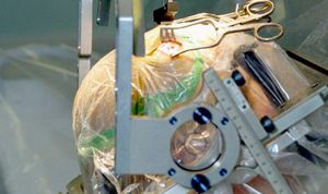 Éxito de la estimulación cerebral no invasiva en pacientes con párkinson