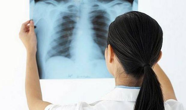 Falta comunicación entre médico y paciente en fibrosis pulmonar idiopática