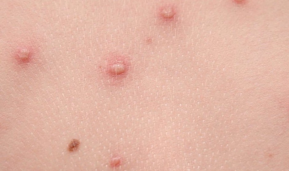 Fiebre, letargo, mialgia o cefaleas: otros síntomas de la viruela del mono