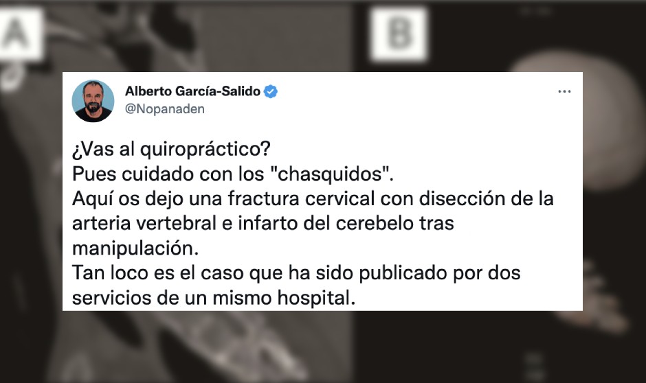 Fractura cervical en el quiropráctico: "El chascar se va a acabar"