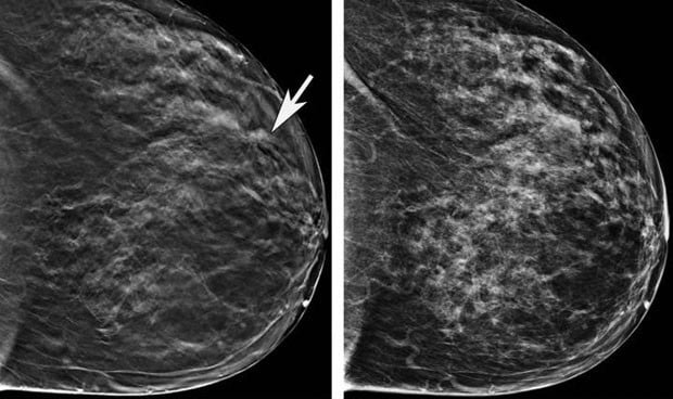 Google es capaz de detectar mejor el cáncer de mama que los radiólogos