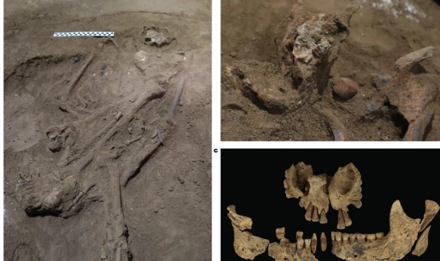 Hallada la prueba más antigua de amputación quirúrgica a un humano