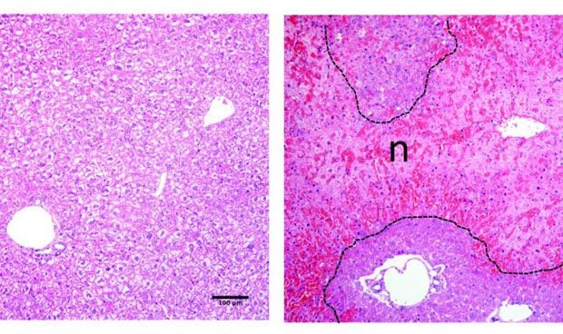 Hallado un posible biomarcador de lesiones hepáticas