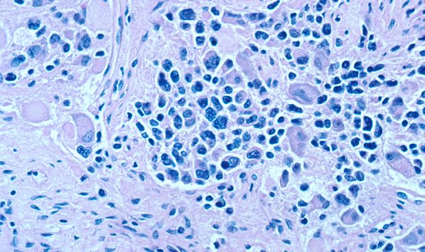 Hallan un diana molecular para mejorar la terapia del neuroblastoma