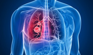 HLA Montpellier conciencia sobre la detección precoz del cáncer de pulmón