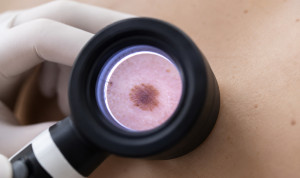  La dermatoscopia permite detectar de forma precoz lesiones sospechosas de cáncer de piel. Autor: HLA Montpellier. 