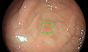 HLA trae a España la inteligencia artificial en endoscopia de Medtronic