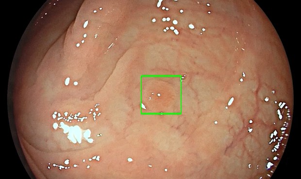 HLA trae a España la inteligencia artificial en endoscopia de Medtronic