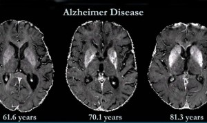 Identifican biomarcadores en sangre que avanzan el riesgo de alzhéimer