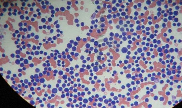 Identifican un factor protector de la leucemia solo para hombres