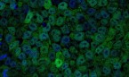 Identifican un mecanismo de diferenciación celular en cáncer de pulmón