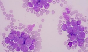 Identifican una clase de quimioterapia más específica contra la leucemia