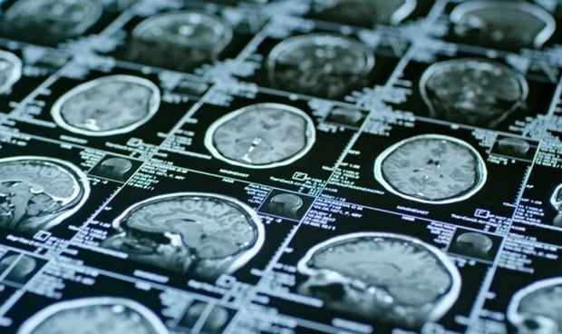 Las imágenes cerebrales predicen el estrés postraumático tras una lesión