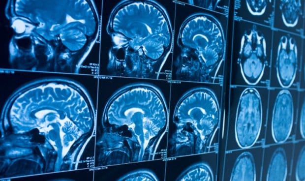 Imágenes del cerebro muestran más síntomas del Covid de lo esperado