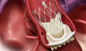 Implantes TAVI, terapia estrella en personas mayores con estenosis aórtica