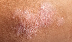 Las infecciones de la piel antes de los 2 años se vinculan con la psoriasis