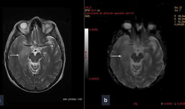 Investigadores registran las 'visiones marianas' a causa de un glioblastoma