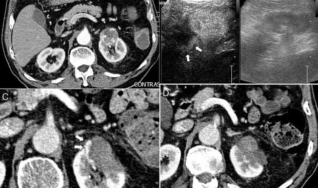 La ablación percutánea en tumor renal logra una supervivencia del 95,26%