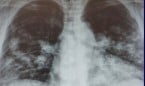La activación de las células basales, clave en terapias de daño pulmonar