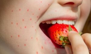 La alergia a los alimentos está relacionada con la exposición a la piel