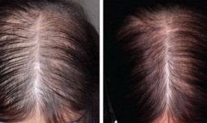 La alopecia en pacientes con cáncer de mama es "parcialmente reversible"