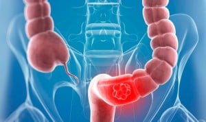 La biopsia líquida detecta un año antes las recaídas en cáncer de colon