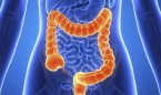 La colonografía por TC permite el diagnóstico precoz de cáncer colorrectal