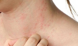 La dermatitis atópica, asociada con tasas más altas de ansiedad y depresión