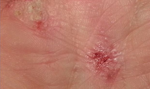 La dermatitis atpica, desvinculada como factor de riesgo cardiovascular