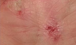 La dermatitis atópica, desvinculada como factor de riesgo cardiovascular