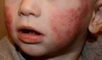 La dermatitis atópica es la patología más común en consultas de Pediatría