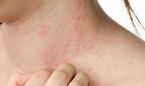 La dermatitis atópica grave puede 