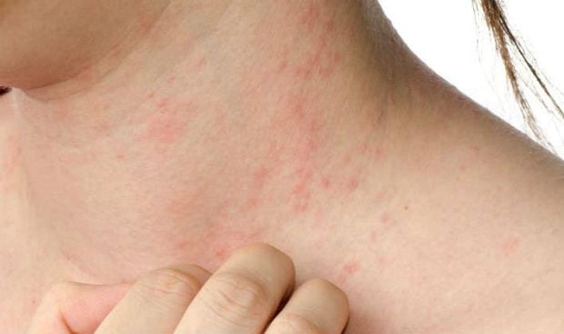 La dermatitis atópica grave puede "destrozar la vida de quien la sufre"