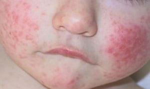 La dermatitis atópica también afecta a la salud mental de los niños